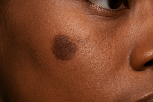 Can dark spots really go away?